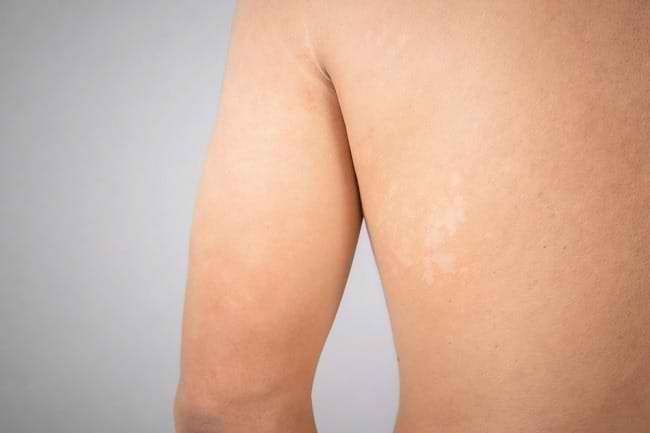 6 Obat Panu Paling Ampuh agar Cepat Sembuh - Alodokter