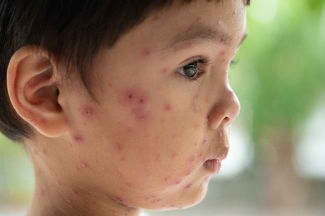 Ciri-Ciri Cacar Air yang Perlu Dikenali dan Diwaspadai - Alodokter
