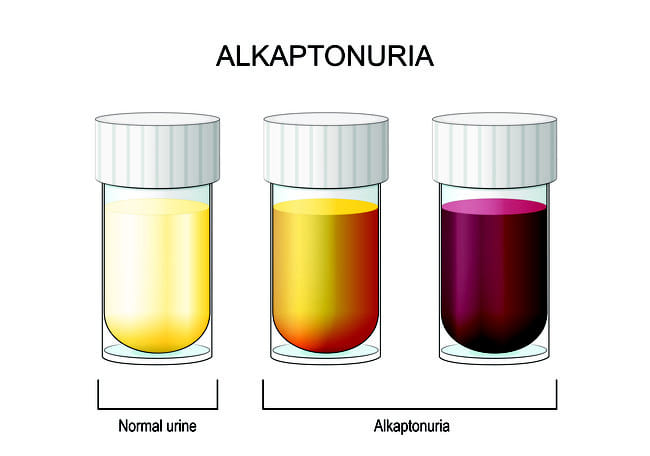 Alkaptonuria - Alodokter