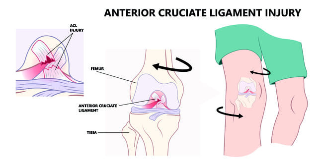 Cedera Ligamen Lutut Anterior - Alodokter