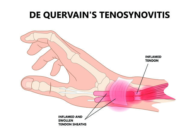De Quervain's Tenosynovitis - Alodokter