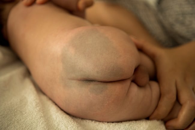 Bercak Mongol - Alodokter