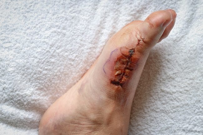 Infeksi Luka Operasi - Alodokter