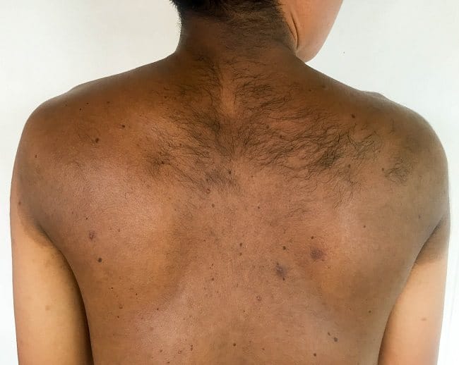 Neurofibromatosis Tipe 1 - Alodokter