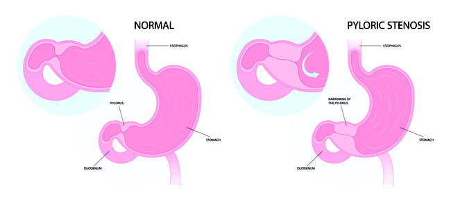 Stenosis Pilorus - Alodokter