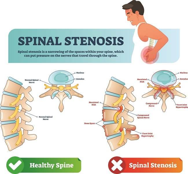 Stenosis Spinal - Alodokter