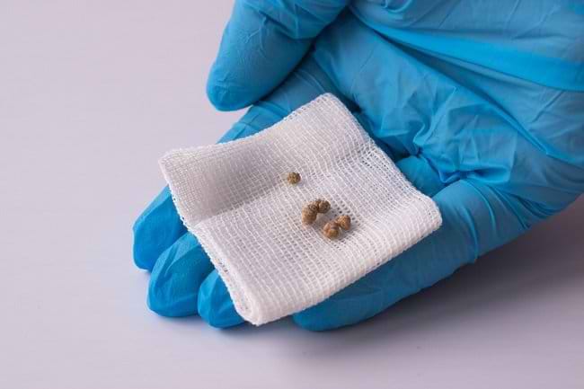 Mengatasi Batu Empedu, Perlu Operasi atau Tidak? - Alodokter