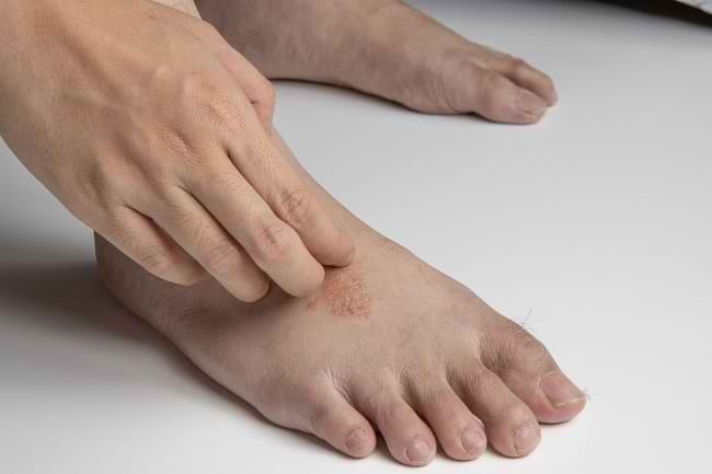 6 Penyakit yang Dapat Terjadi Akibat Jamur Candida Albicans - Alodokter