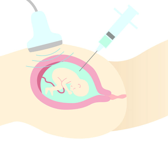 Amniocentesis, Ini yang Harus Anda Ketahui - Alodokter