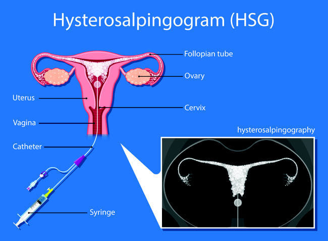 Histerosalpingografi, Ini yang Harus Anda Ketahui - Alodokter