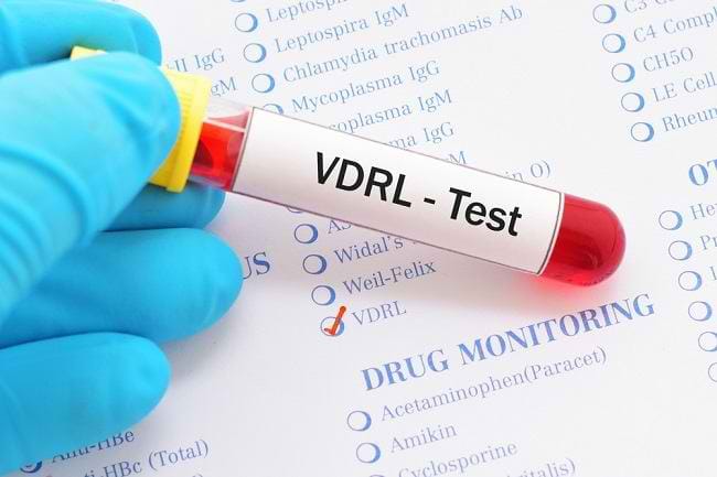 Mengenal Tes VDRL untuk Deteksi Penyakit Sifilis - Alodokter