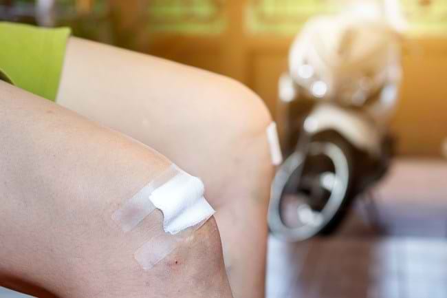 6 Langkah Mengobati Luka Jatuh dari Motor - Alodokter