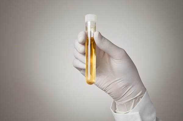 Ketahui Apa Itu Kultur Urine - Alodokter