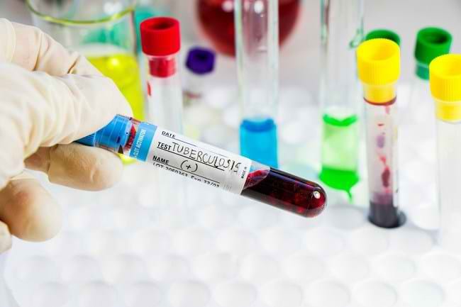 Mengenal Berbagai Jenis Tes TB - Alodokter