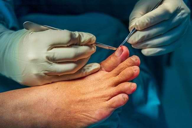 6 Cara Perawatan Kaki Penderita Diabetes yang Benar - Alodokter