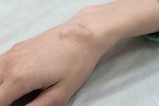 Cara Membedakan Benjolan yang Berbahaya dan Tidak - Alodokter