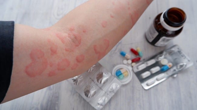 Obat Biduran di Apotek dan dengan Resep Dokter - Alodokter