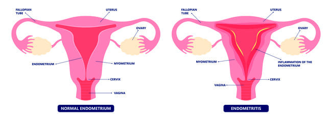 Endometritis - Alodokter