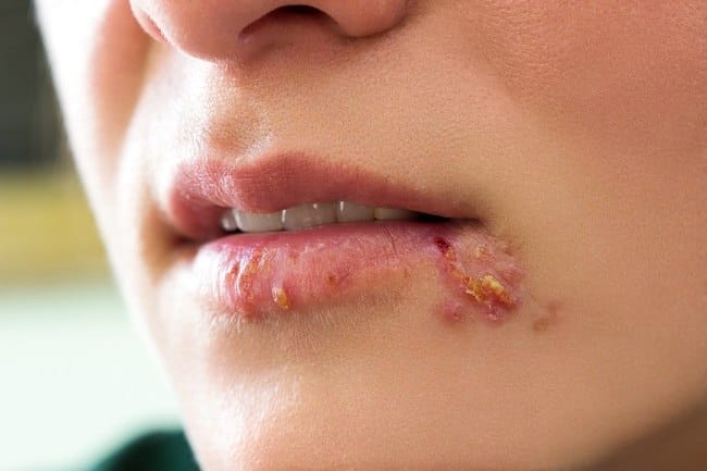 Herpes Bibir - Alodokter