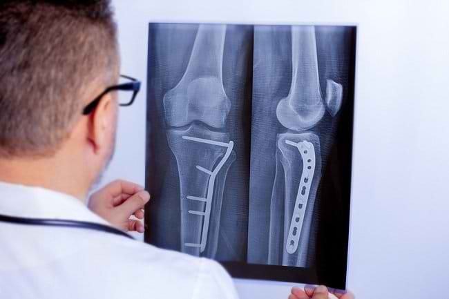 Kapan Prosedur Cabut Pen Perlu Dilakukan? - Alodokter