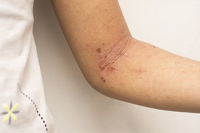Dermatitis Atopik - Alodokter