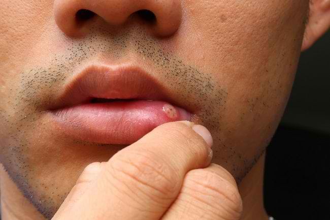 5 Pilihan Obat Sariawan di Bibir secara Alami - Alodokter