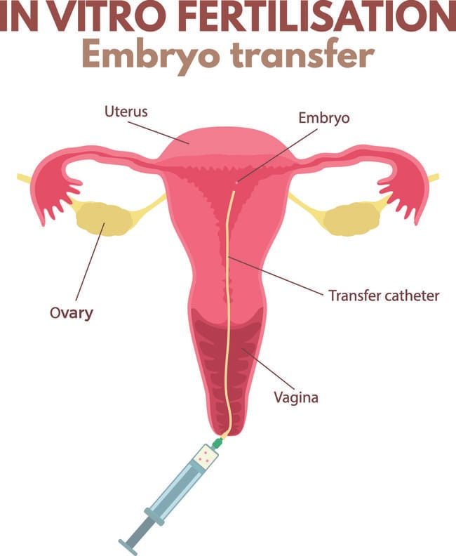 Ketahui Apa Itu Kultur dan Transfer Blastosis Embrio - Alodokter