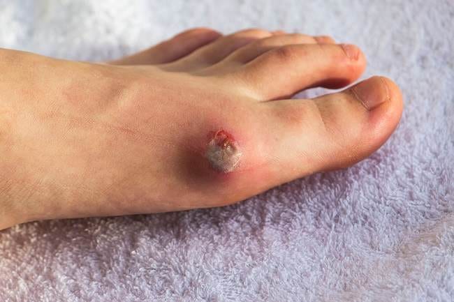 5 Obat Luka Diabetes di Apotek yang Manjur - Alodokter