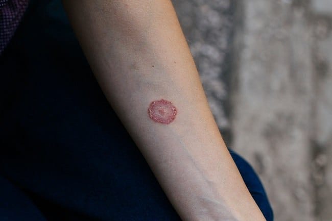 Ketahui Penyebab Kurap, Gejala, dan Cara Mencegahnya - Alodokter