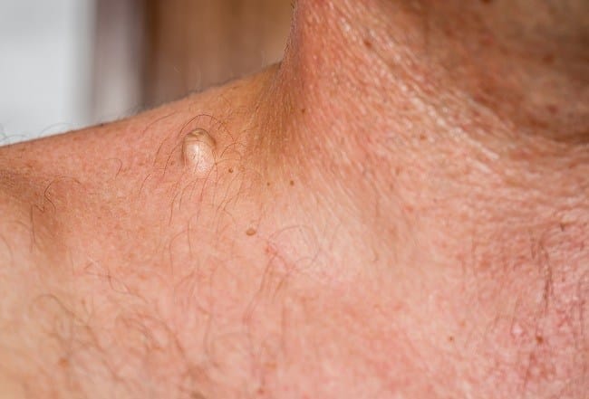 Kista Ateroma - Alodokter