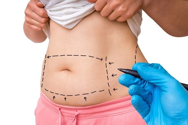 Mengenal Manfaat dan Risiko Tummy Tuck - Alodokter
