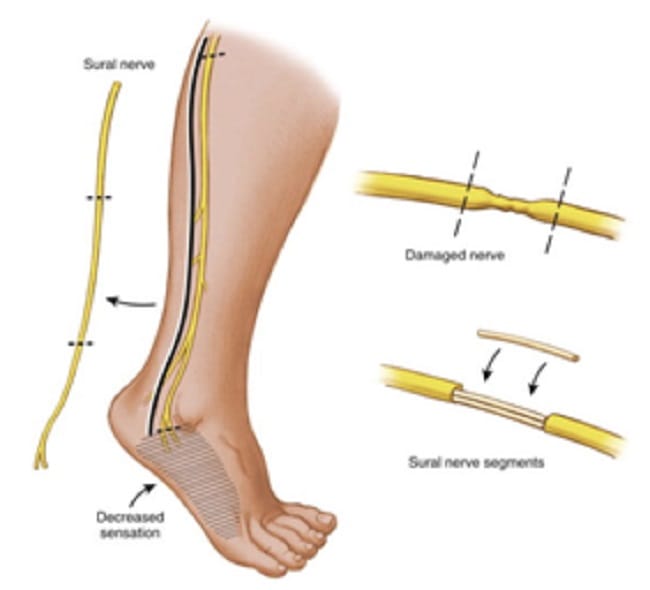 Transplantasi Saraf, Ketahui Prosedur dan Kegunaannya - Alodokter