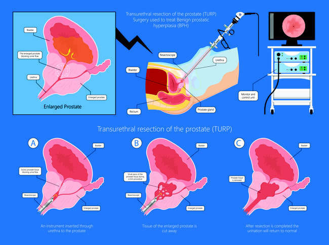 Mengenal Tentang Operasi Prostat - Alodokter