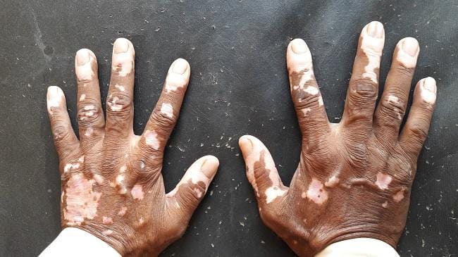 Methoxsalen - Alodokter