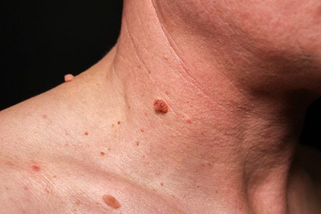 4 Obat Kutil di Leher yang Paling Ampuh - Alodokter