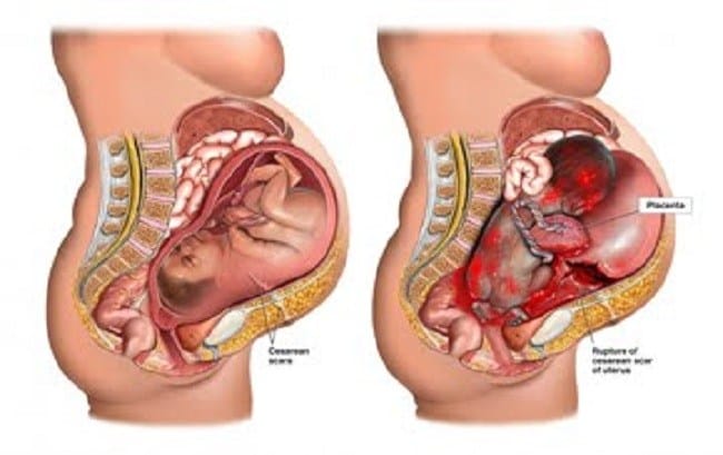 Ruptur Uteri - Alodokter