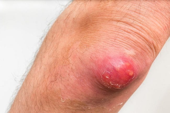 5 Salep Bisul di Apotek dan Cara Kerjanya - Alodokter