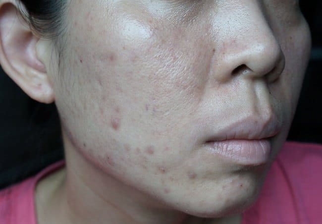 11 Cara Menghilangkan Bekas Jerawat Hitam di Pipi - Alodokter