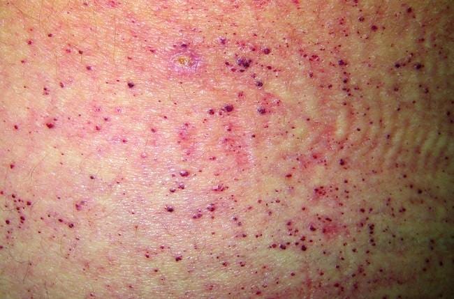 Penyakit Fabry - Alodokter