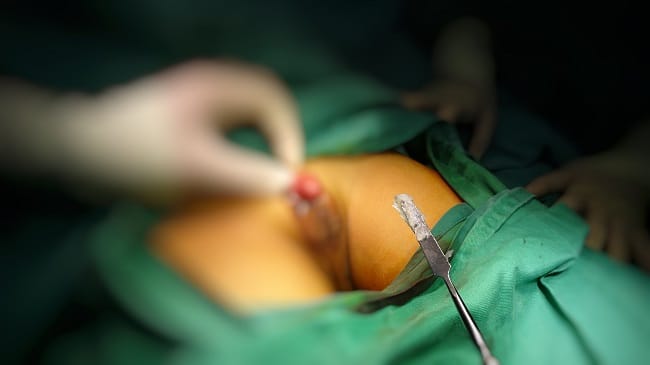 Sunat, Ini yang Harus Anda Ketahui - Alodokter