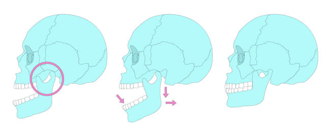 Dislokasi Rahang - Alodokter