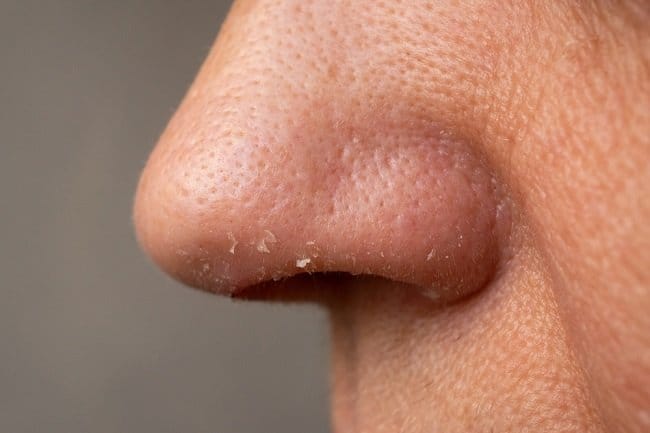 5 Penyebab Pori-Pori Besar dan Cara Mengecilkannya - Alodokter