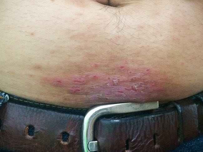 Dermatitis Kontak - Alodokter