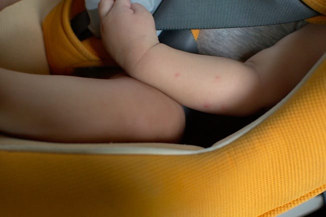 5 Cara Menghilangkan Bekas Gigitan Nyamuk pada Bayi - Alodokter