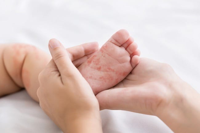 Campak pada Anak, Kenali Penyebab dan Pencegahannya - Alodokter