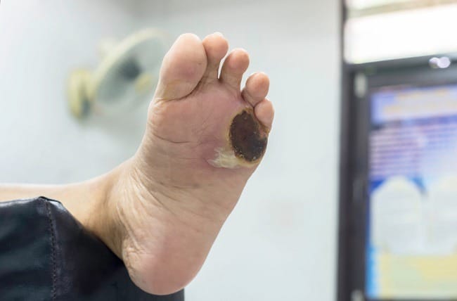 Nekrosis, Kondisi Matinya Jaringan Tubuh - Alodokter