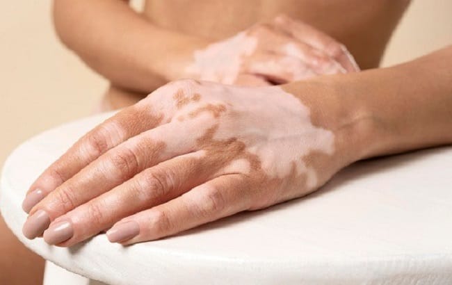5 Gejala Awal Vitiligo yang Perlu Diketahui - Alodokter