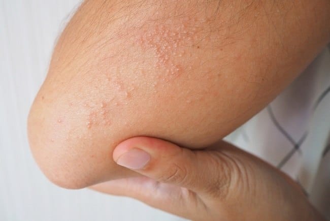 6 Obat Biang Keringat Dewasa yang Ampuh Usir Rasa Gatal - Alodokter