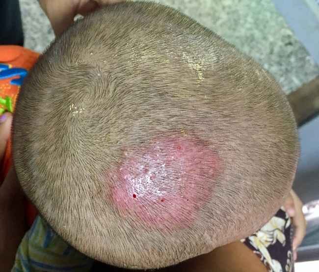 griseofulvin-alodokter