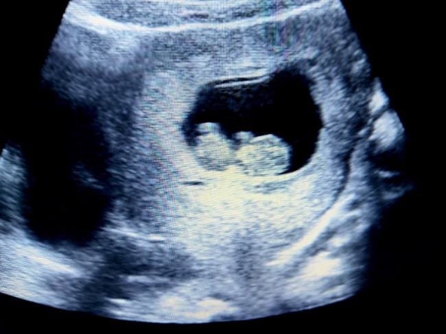 Janin 10 Minggu, Inilah Perkembangan dan Tips Menjaga Kesehatannya - Alodokter